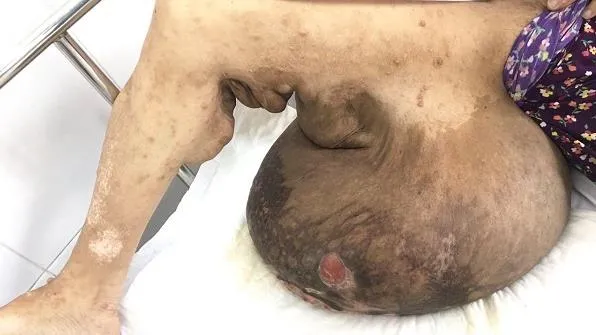 Bệnh viện Chợ Rẫy tổ chức chương trình khám sàng lọc cho bệnh nhân bị u sợi thần kinh