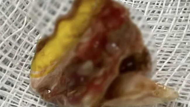 Ho ra máu dai dẳng gần 2 năm vì dị vật vào phổi