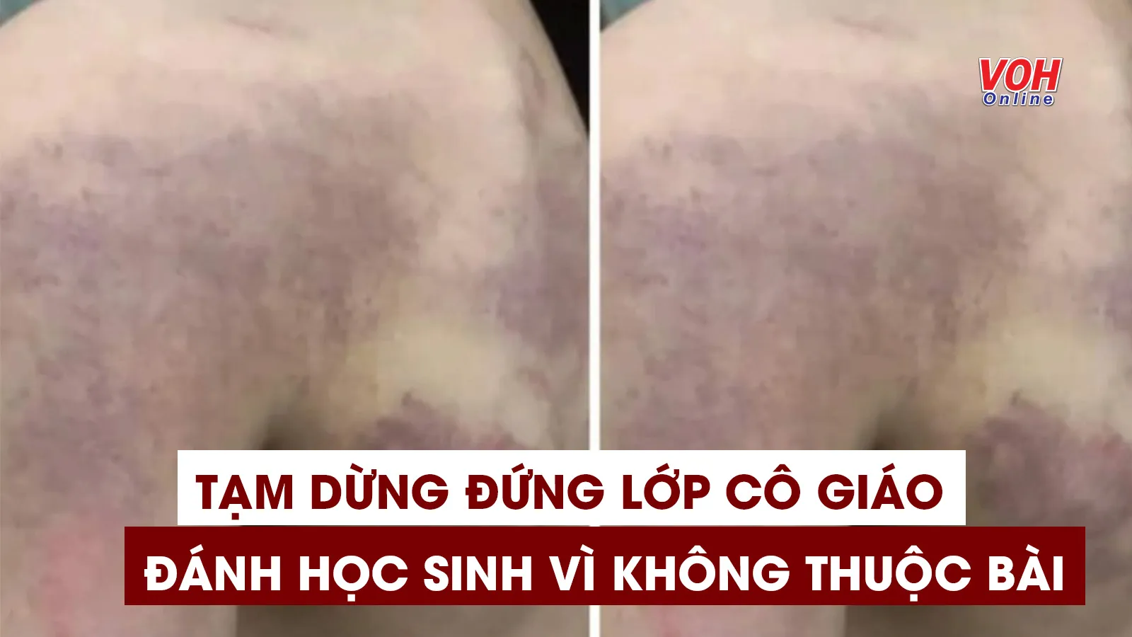 Tin nhanh chiều 11/5: Tạm đình chỉ công tác giáo viên đánh học sinh bầm tím lưng vì không thuộc bài