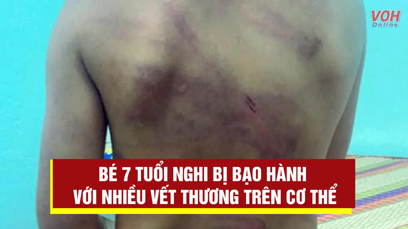 Tin nhanh trưa 28/7: Bé 7 tuổi nghi bị bạo hành với nhiều vết thương trên cơ thể