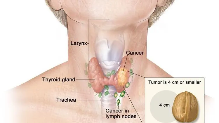 Ung thư tuyến giáp dưới góc nhìn ngoại khoa