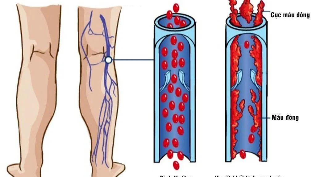Phù chi dưới, loét tĩnh mạch do huyết khối tĩnh mạch sâu