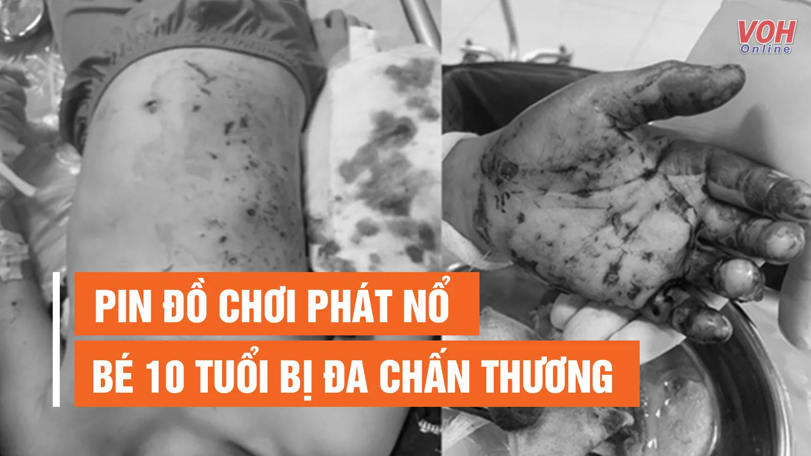 Tin nhanh sáng 12/8: Pin đồ chơi phát nổ, bé 10 tuổi bị đa chấn thương