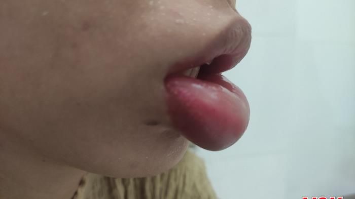Khuyến cáo về những tai biến sau tiêm filler vùng môi