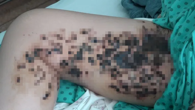 Nhiễm trùng nặng sau điều trị rạn da