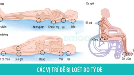 Dự phòng và chăm sóc loét do đè ép như thế nào?