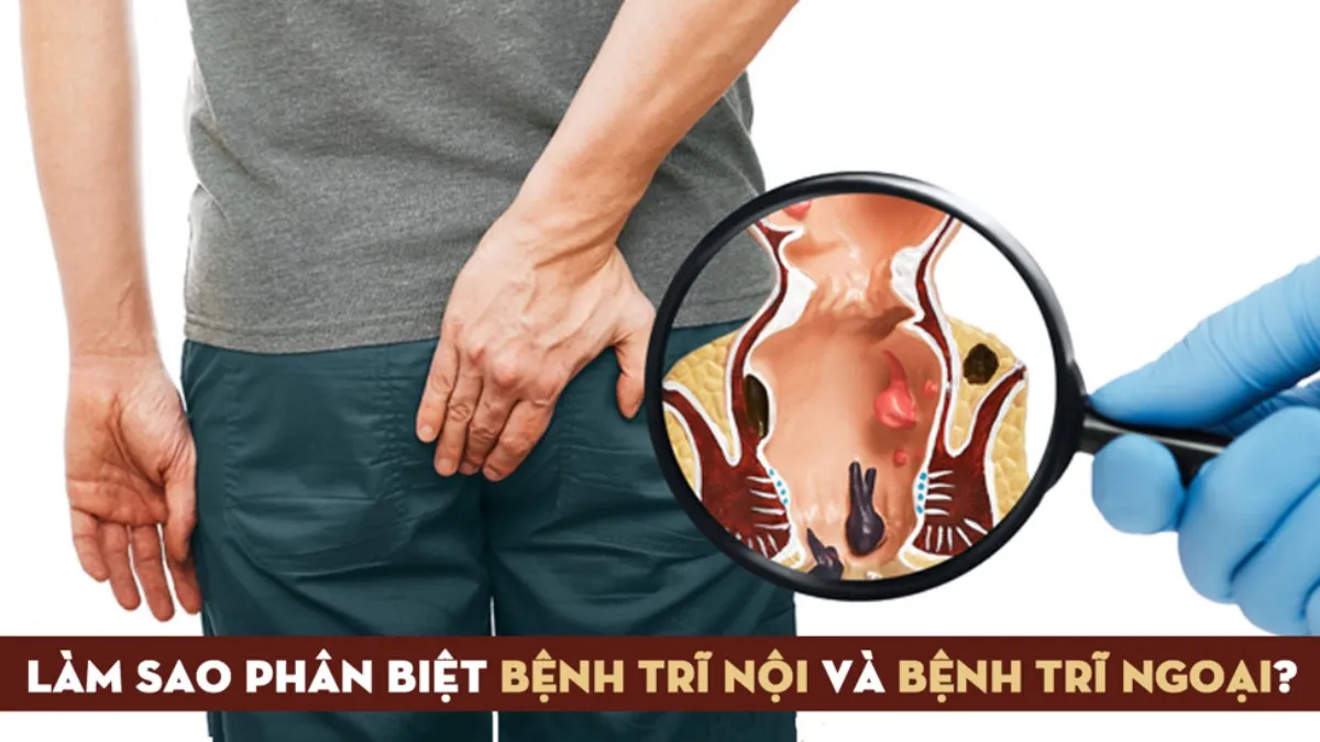 Cách phân biệt trĩ nội và trĩ ngoại đơn giản tại nhà