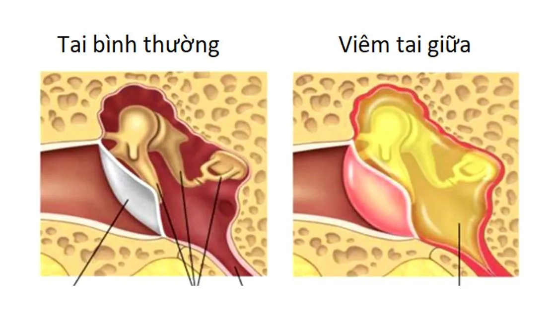 Viêm tai giữa ở trẻ em chẩn đoán và xử trí tại nhà như thế nào?