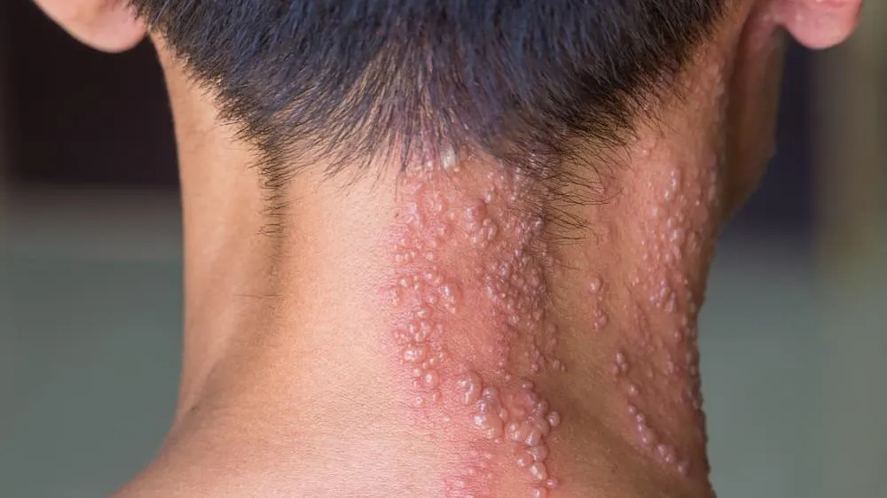 Phát hiện, xử trí và điều trị bệnh Zona