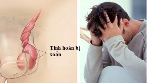 Xoắn tinh hoàn, bệnh thường gặp ở lứa tuổi thiếu niên