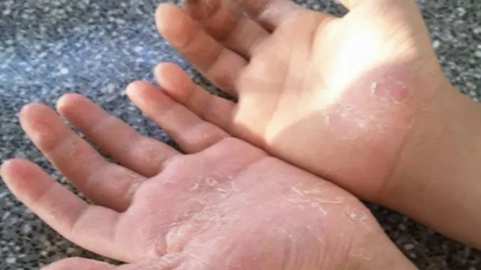 Cảnh báo bệnh á sừng tay, chân và cách phòng tránh