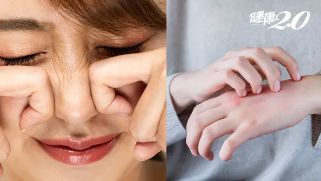 Dị ứng, ngứa da ăn uống như thế nào?