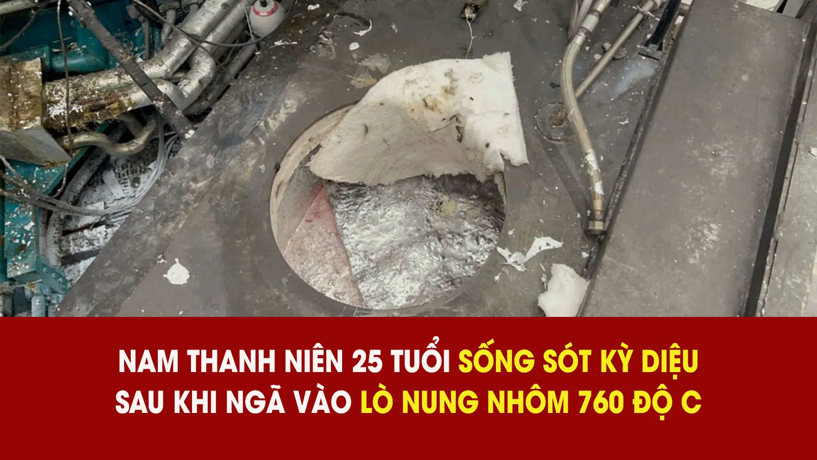 Bị ngã vào lò nung 760 độ C, nam thanh niên tự thoát ra ngoài, sống sót một cách kỳ diệu