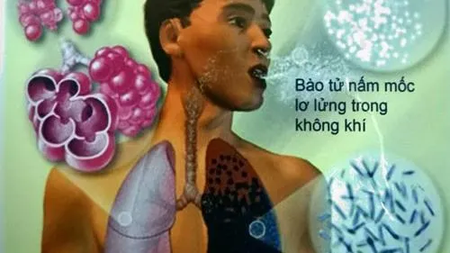 Nấm đất histo xuất hiện khắp nước Mỹ, gây ra bệnh phổi ở 48/50 bang