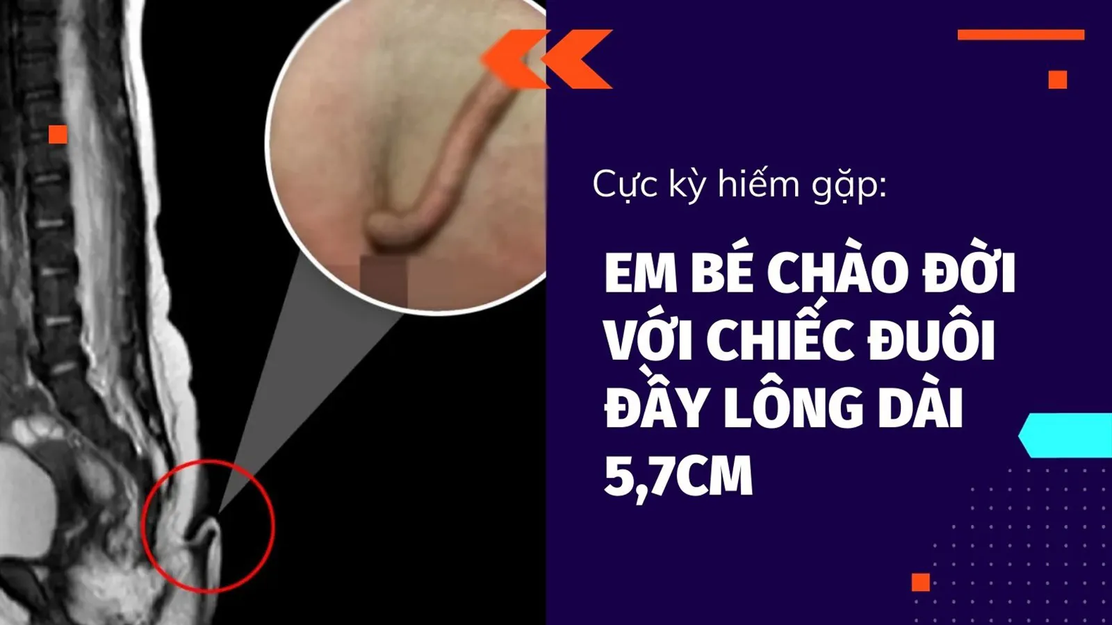 Kỳ lạ em bé chào đời với chiếc đuôi đầy lông dài 5,7cm