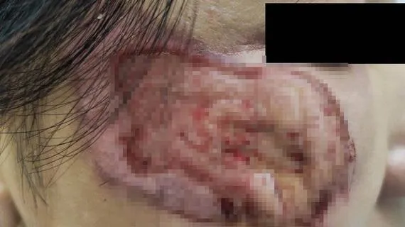 Mua mỹ phẩm chứa axit trị nám, nhiễm trùng lở loét gò má