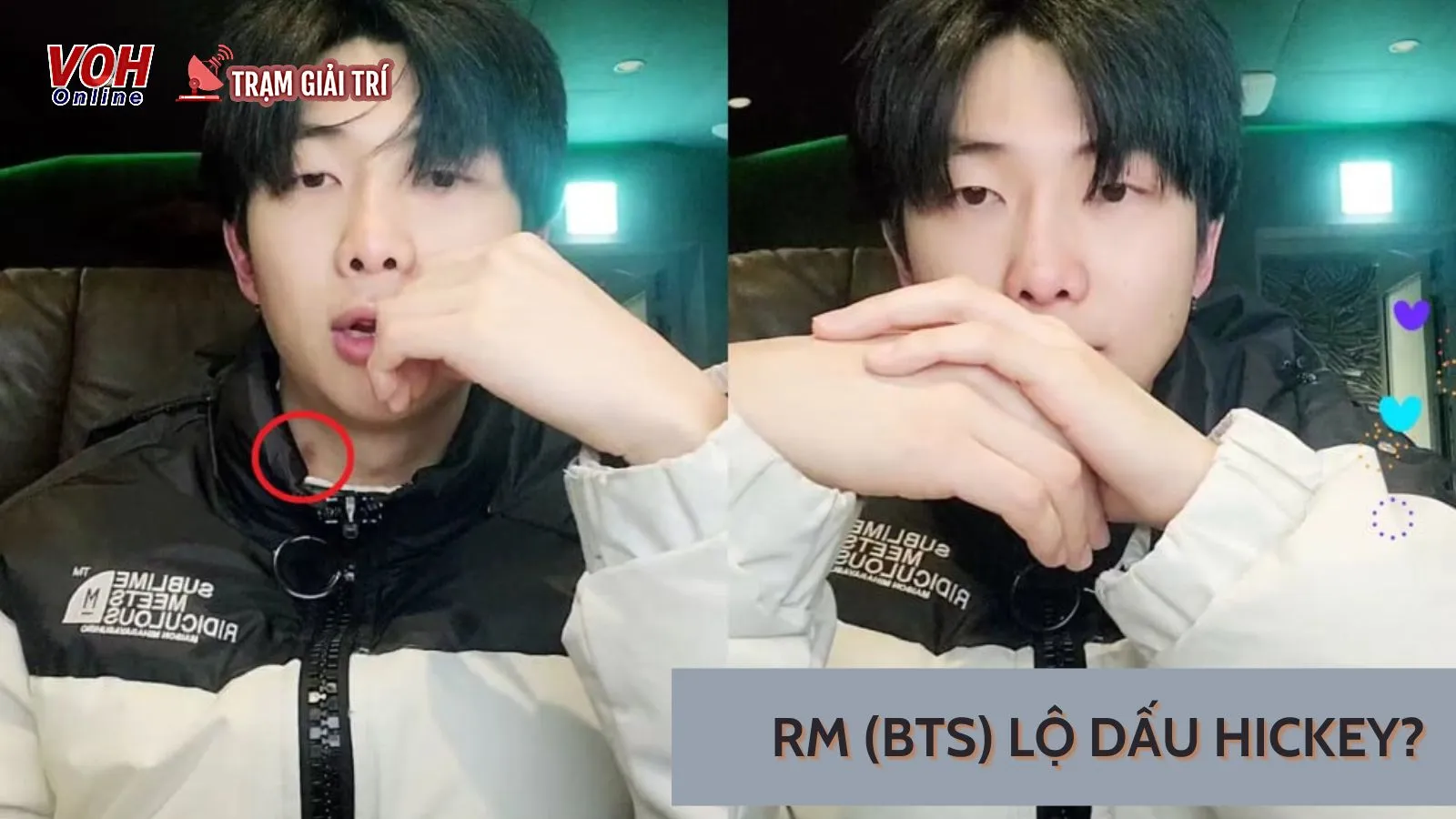 RM (BTS) lộ vết bầm kỳ lạ ở cổ, người hâm mộ nghi ngờ có phải dấu hickey