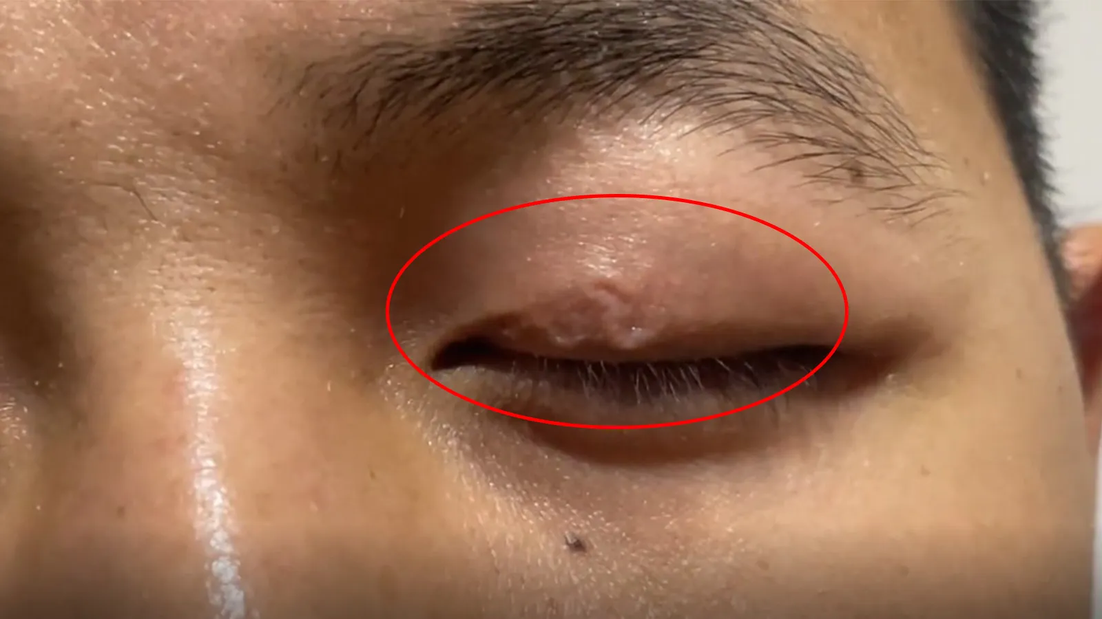 Bị giun ký sinh trong mí mắt, người đàn ông lên mạng cầu cứu