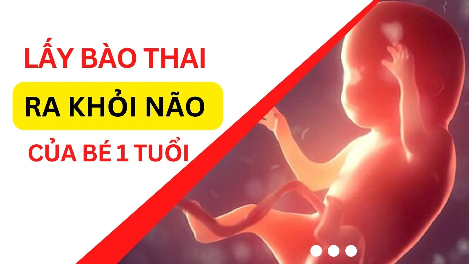 Phẫu thuật lấy bào thai song sinh còn sống trong hộp sọ bé 1 tuổi