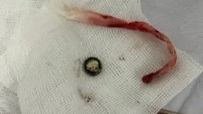 Nhét pin cúc áo vào mũi, bé gái 3 tuổi bị hoại tử một phần niêm mạc mũi