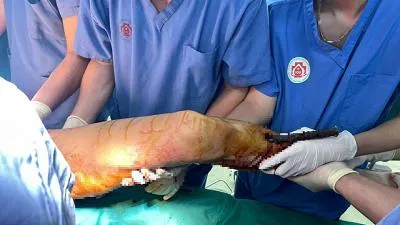 Cấp cứu kịp thời nam thanh niên ngã từ tầng 5 xuống cọc bê tông