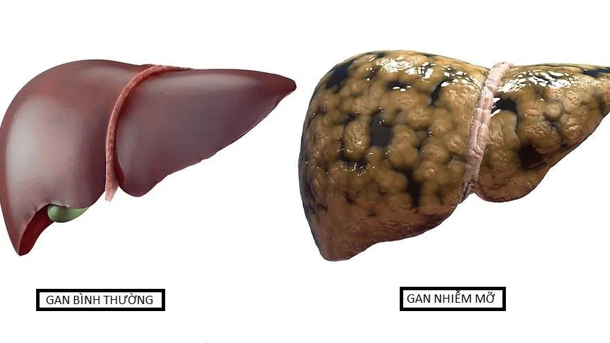 Làm thế nào đẩy lùi gan nhiễm mỡ?