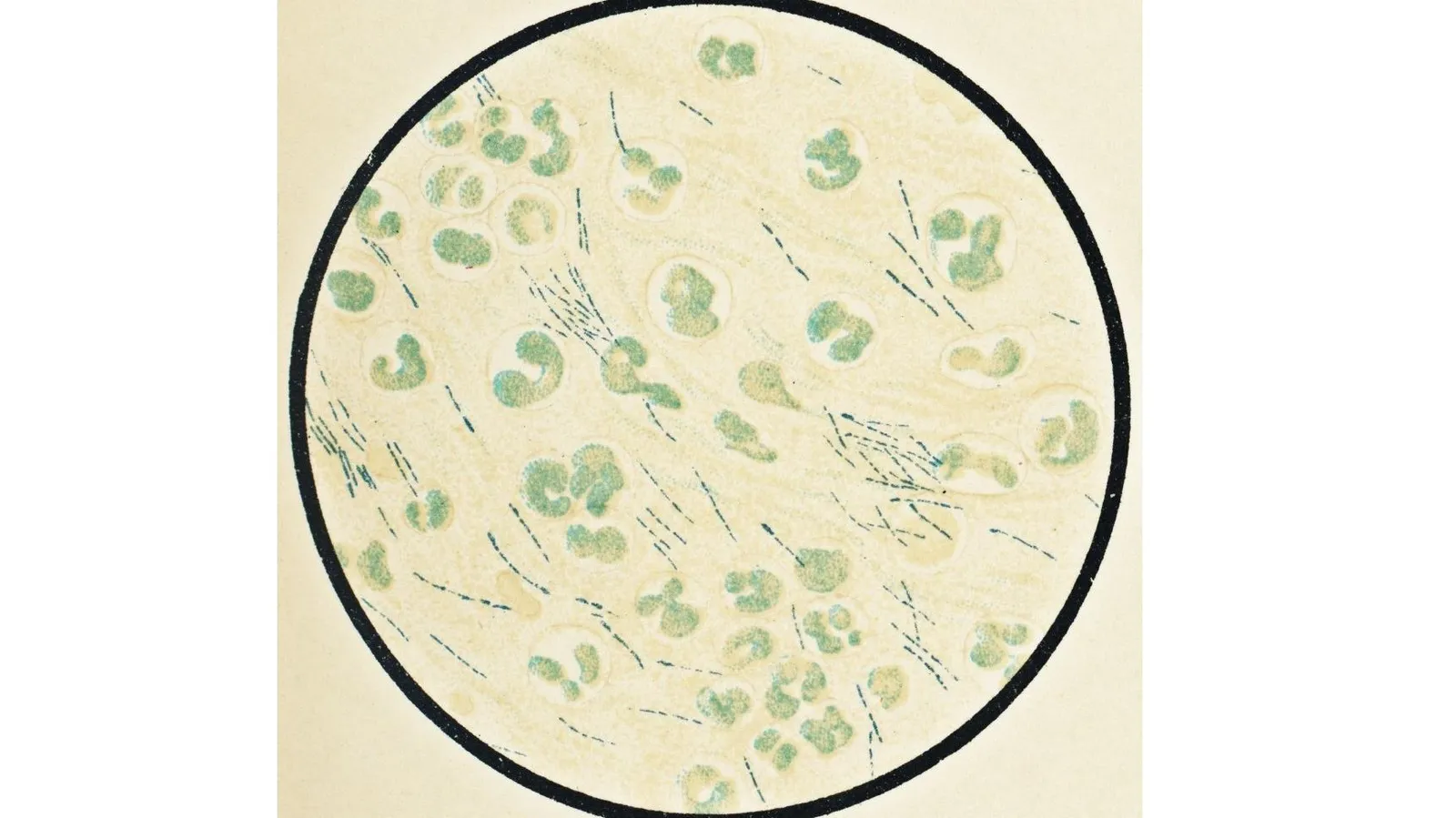 Mỹ: Cảnh báo về vi khuẩn chết người với tỷ lệ tử vong 50%