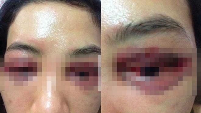 “Làm mẫu cắt mí”, cô gái 20 tuổi bị biến dạng mắt