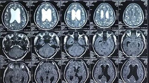 Đau đầu nhiều năm do sán làm tổ trong não