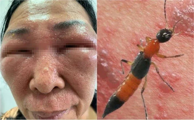 Bóp kiến ba khoang rồi dụi mắt, người phụ nữ bị tổn thương mắt nặng