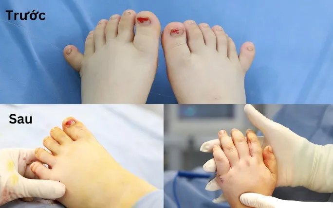 Loại bỏ ngón thừa cho bé gái có 12 ngón tay, 12 ngón chân