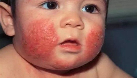 Làm thế nào để tránh khỏi bệnh chàm trong mùa hè?