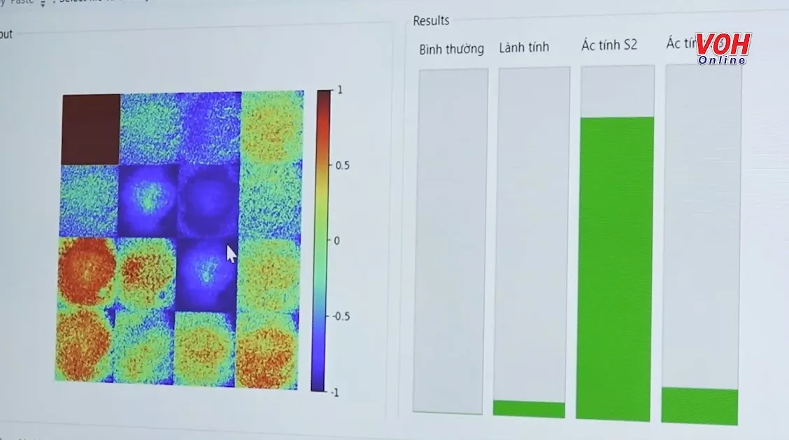 Ứng dụng AI kết hợp hệ thống phân cực ánh sáng và hình ảnh mô bệnh học trong chẩn đoán ung thư vú