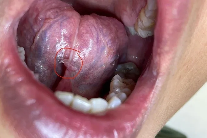 Đi bar, hôn cô gái lạ, nam thanh niên mắc sùi mào gà