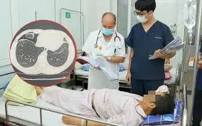Ăn gỏi cua sống đặc sản, người đàn ông nhiễm sán lá phổi
