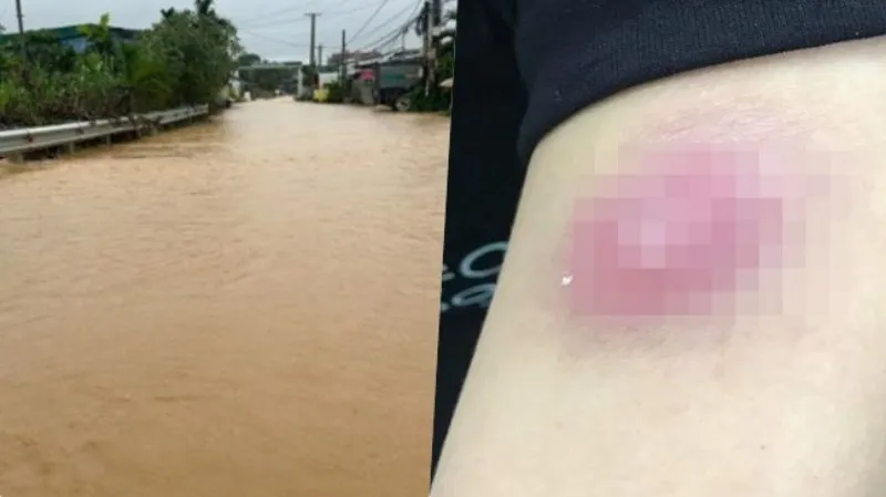 Điểm tin chiều 26/8: Phố núi Bảo Lộc ngập nặng | Tiêm tan mỡ nhận kết đắng