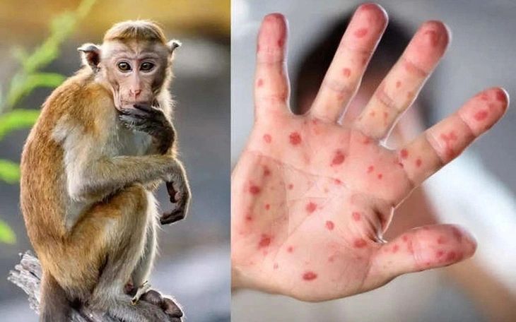 Hai bệnh nhân mắc đậu mùa khỉ đã ổn định, đang được cách ly