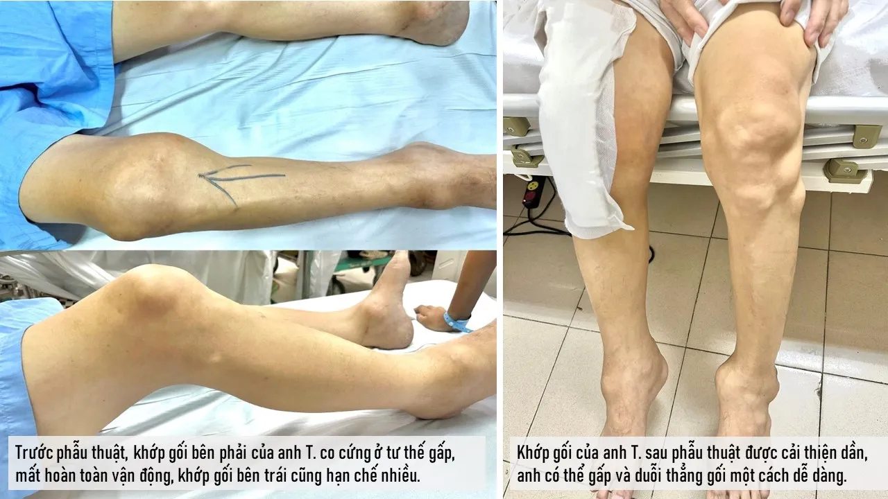 Thay khớp gối cho bệnh nhân 40 tuổi mắc bệnh gút 20 năm