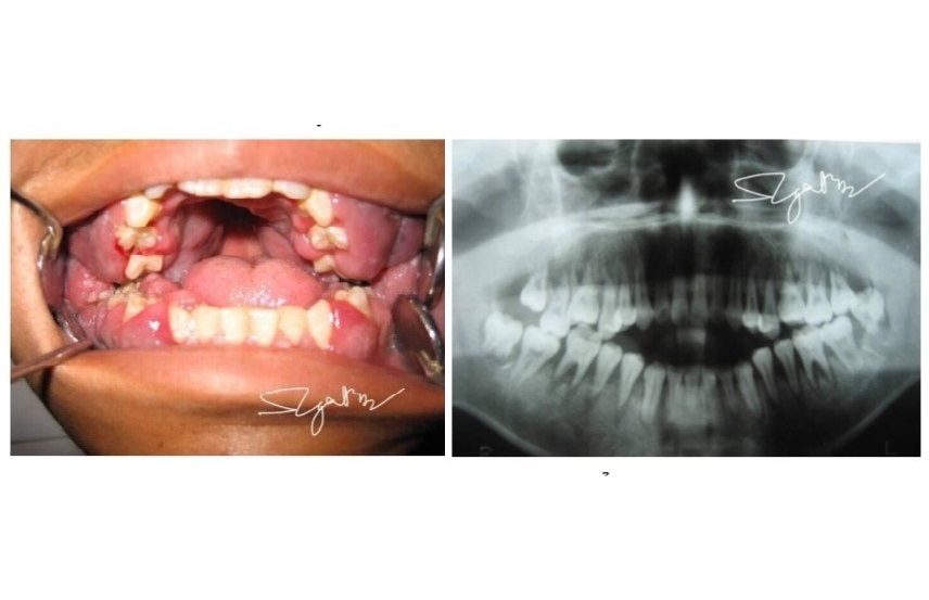 Phát hiện bệnh u máu ác tính sau khi sưng lợi, răng lung lay