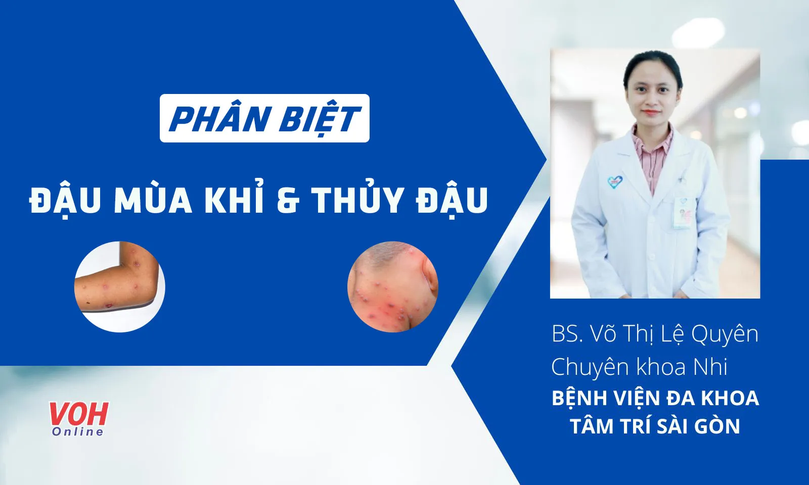 Cách phân biệt bệnh thủy đậu và đậu mùa khỉ