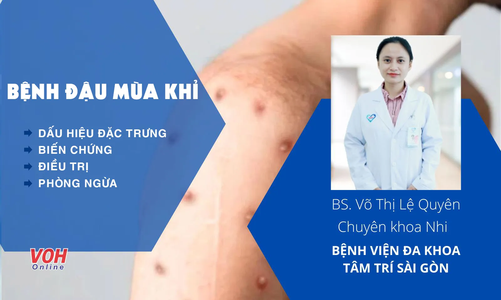 Dấu hiệu đặc trưng của bệnh đậu mùa khỉ và cách phòng ngừa