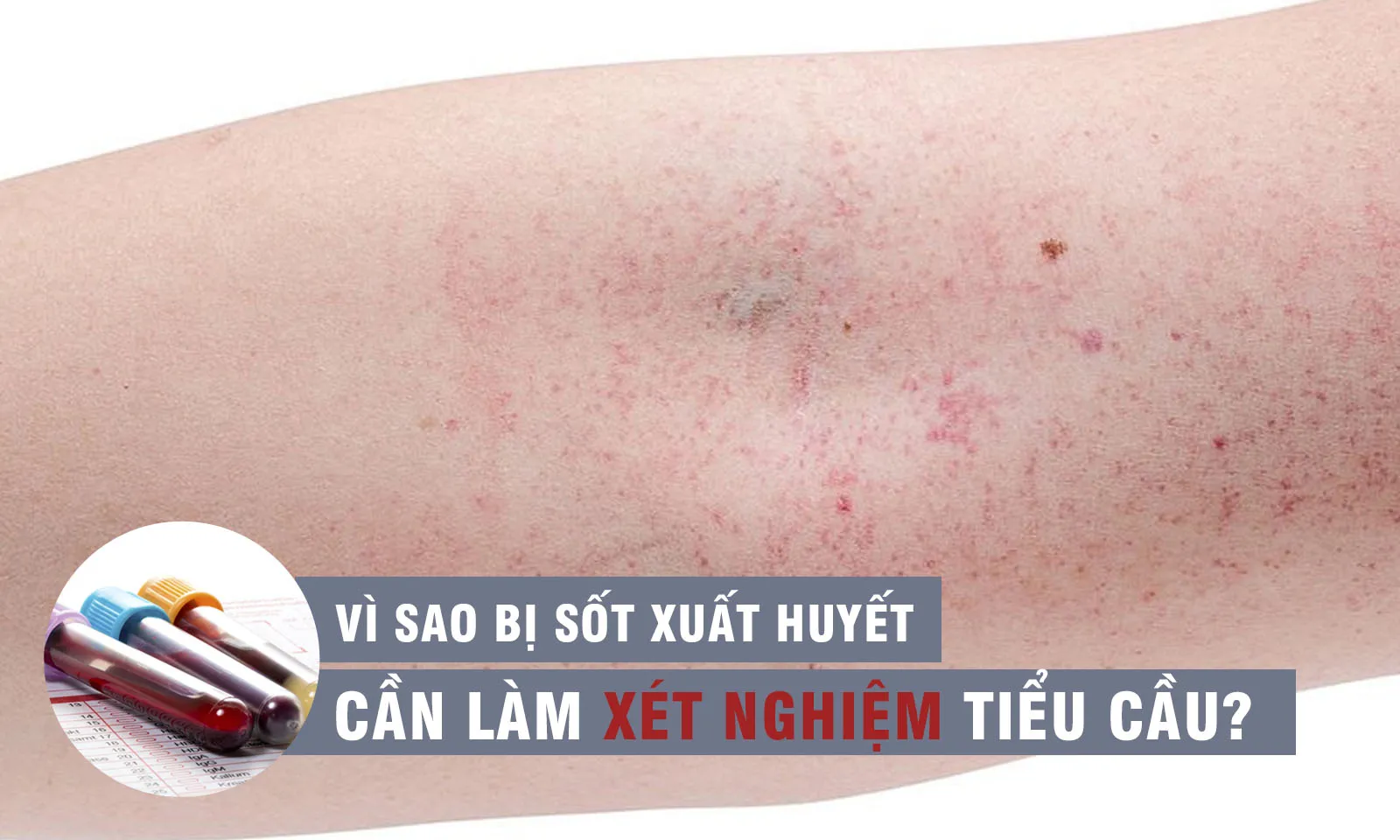 Vì sao cần làm xét nghiệm theo dõi tiểu cầu trong điều trị sốt xuất huyết?