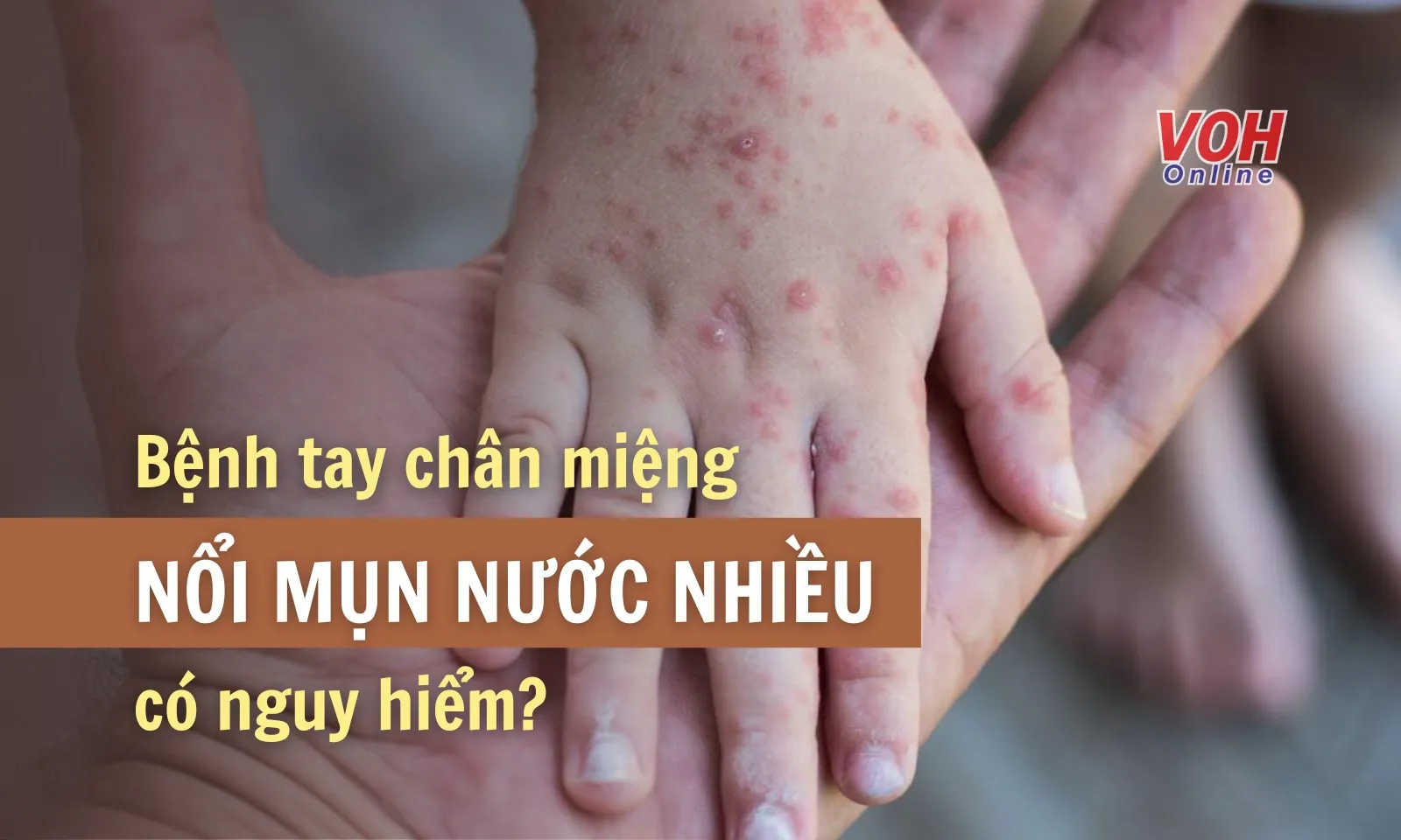 Trẻ mắc tay chân miệng nổi mụn nước nhiều có sao không?