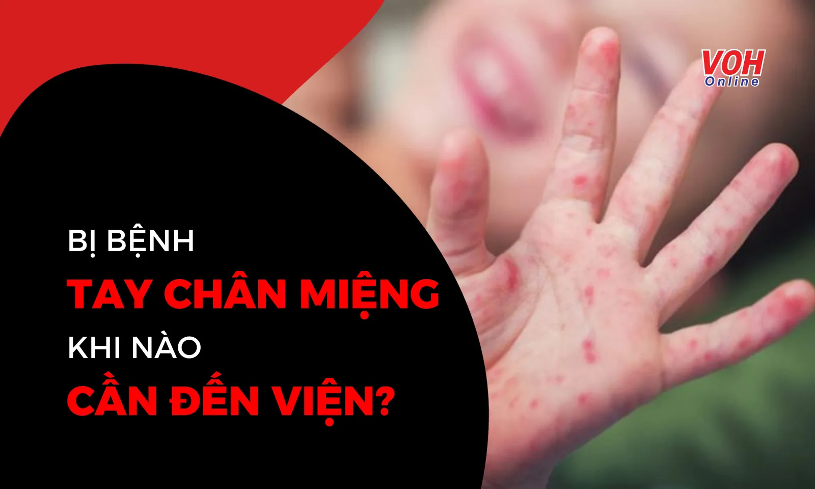 Bệnh Tay Chân Miệng khi nào cần đến viện?