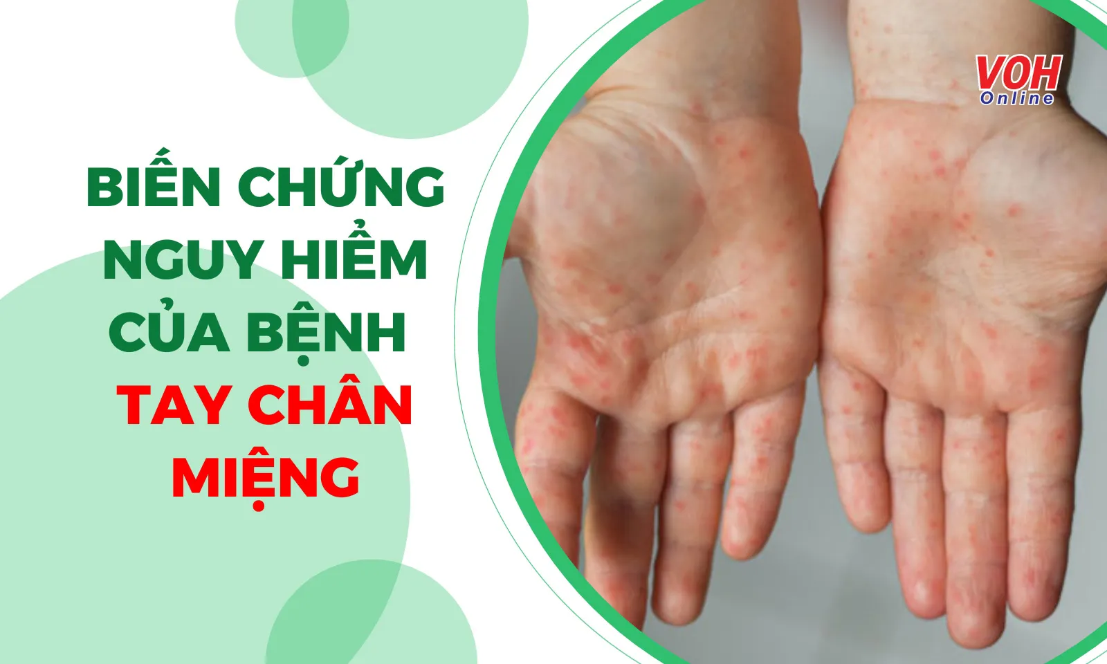 Biến chứng nguy hiểm của bệnh Tay Chân Miệng