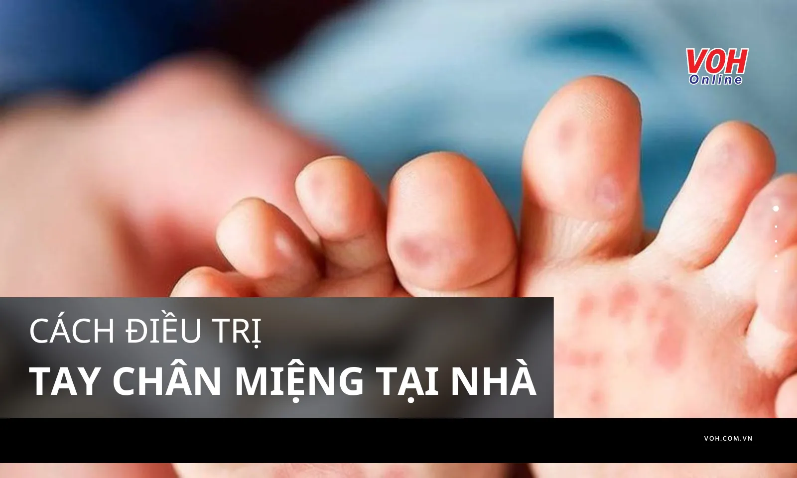 Cách điều trị Tay Chân Miệng tại nhà