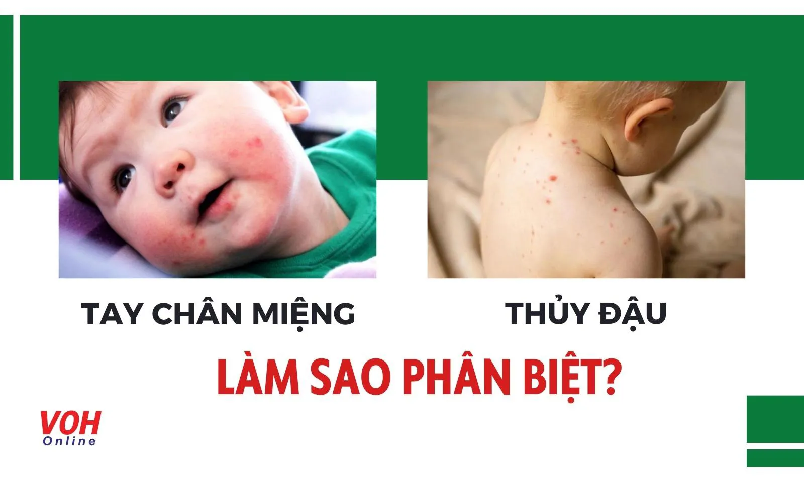 Làm thế nào phân biệt Tay Chân Miệng với các bệnh có cùng triệu chứng?