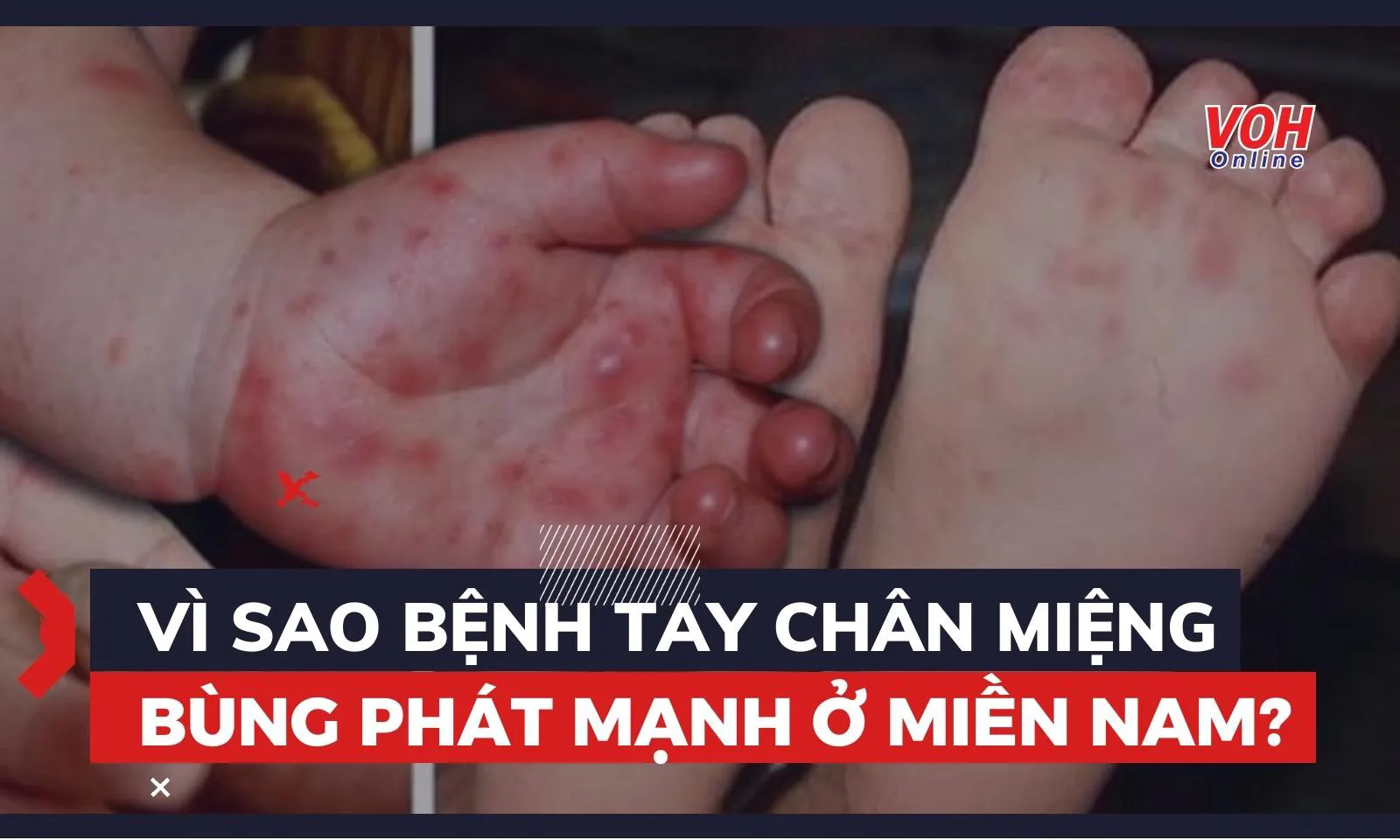 Vì sao bệnh Tay Chân Miệng bùng phát mạnh ở miền Nam?