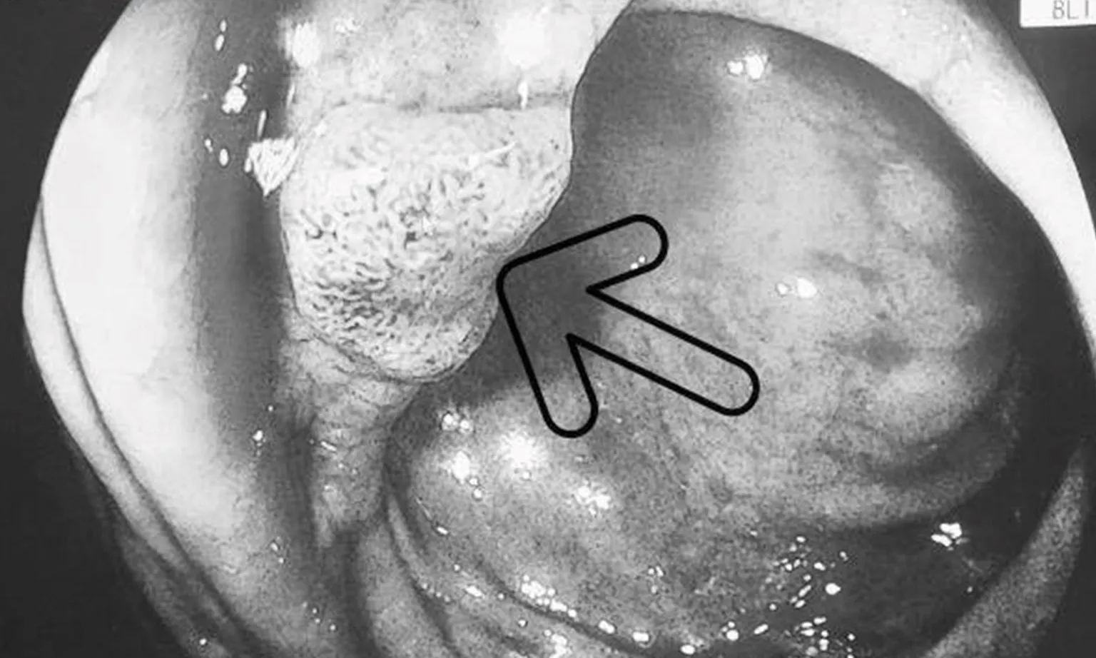 Sụt cân, ăn uống kém đi tầm soát phát hiện ung thư thực quản