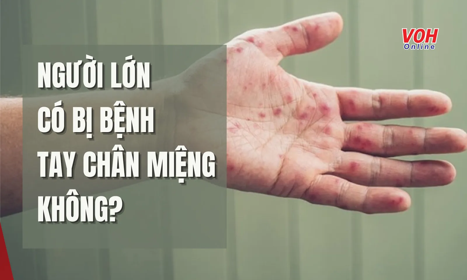 Người lớn mắc Tay Chân Miệng: Đừng chủ quan!